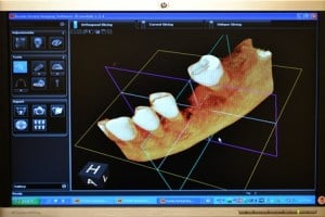 CT Scan Screenshot od a missing lower tooth